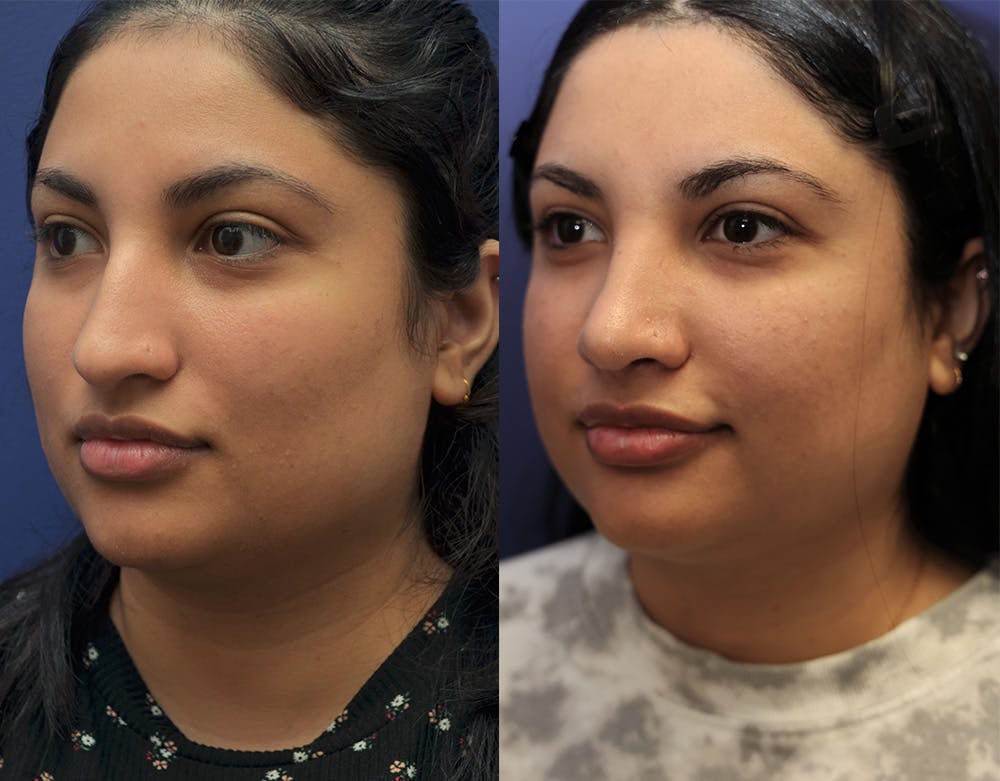 Rhinoplasty (Nose Reshaping) Before & After Gallery - Patient 141526208 - Image 5