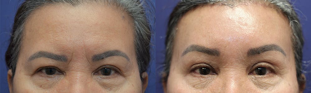 Brow Lift (Forehead Lift) Before & After Gallery - Patient 144657122 - Image 1