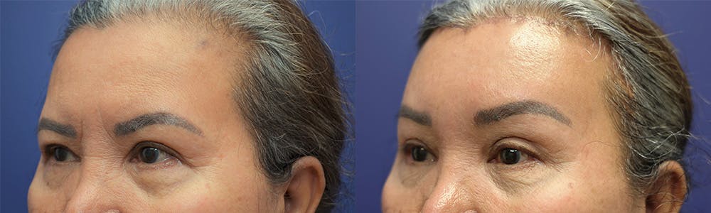 Brow Lift (Forehead Lift) Before & After Gallery - Patient 144657122 - Image 3