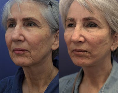 Neck Lift Before & After Gallery - Patient 144657199 - Image 1