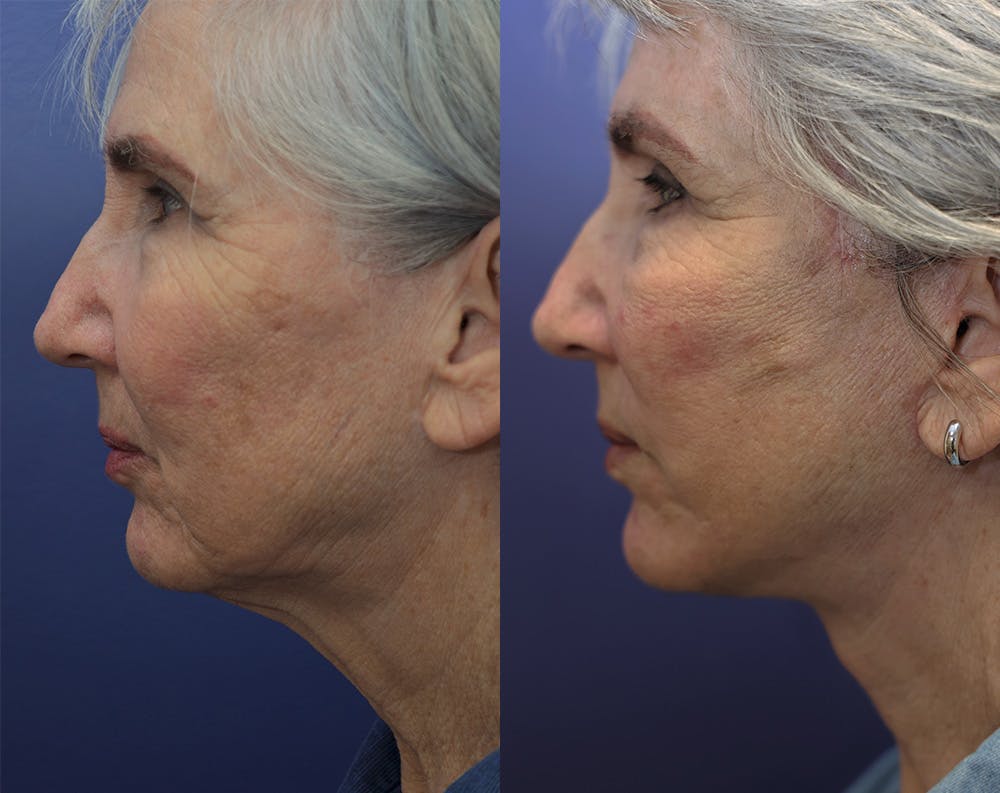 Deep Plane Neck Lift Before & After Gallery - Patient 144657199 - Image 3