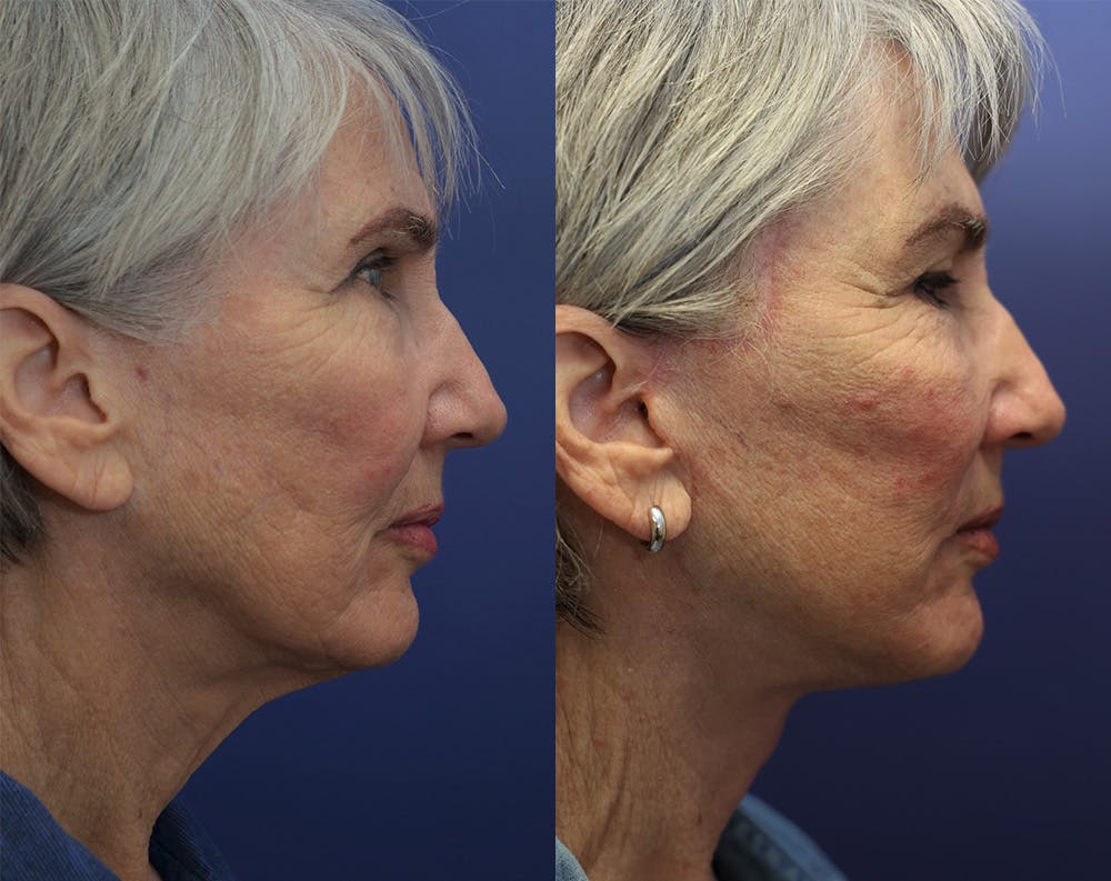 Deep Plane Neck Lift Before & After Gallery - Patient 144657199 - Image 5