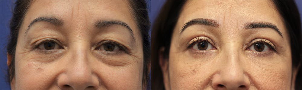Eyelid Surgery Before & After Gallery - Patient 144657202 - Image 1