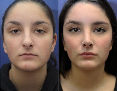Lip Lift Before & After Gallery - Patient 144711159 - Image 1