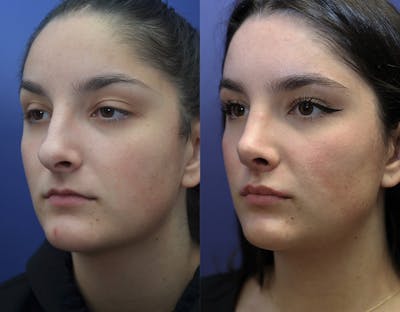 Rhinoplasty (Nose Reshaping) Before & After Gallery - Patient 144711156 - Image 1