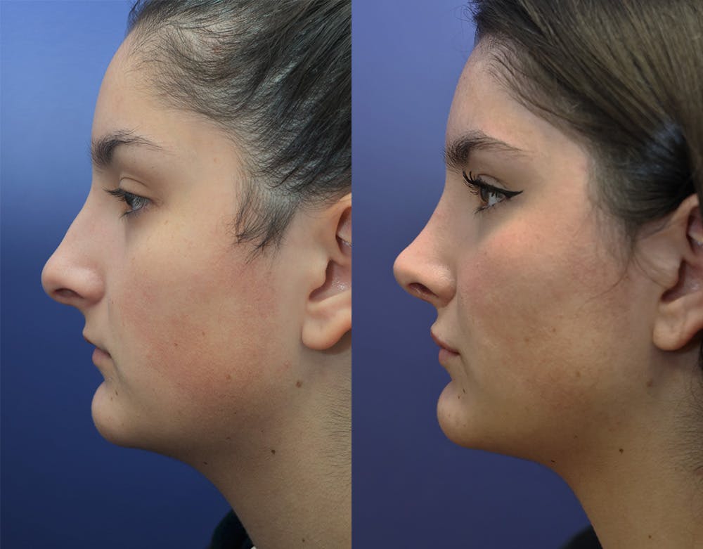 Rhinoplasty (Nose Reshaping) Before & After Gallery - Patient 144711156 - Image 2