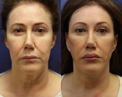 Lip Lift Before & After Gallery - Patient 147104395 - Image 1