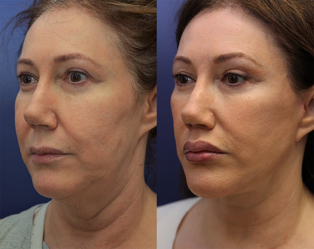 Deep Plane Facelift Before & After Gallery - Patient 147104379 - Image 1