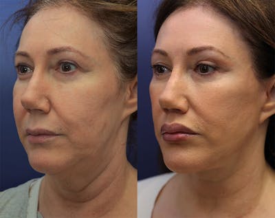 Brow Lift (Forehead Lift) Before & After Gallery - Patient 147104392 - Image 4