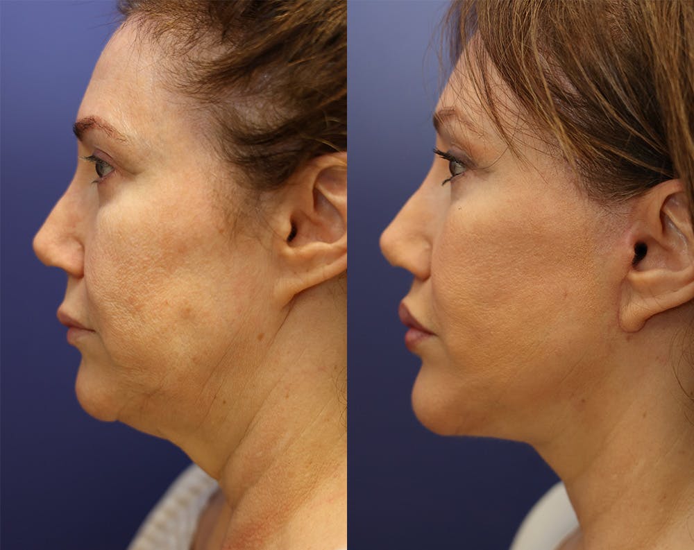Lip Lift Before & After Gallery - Patient 147104395 - Image 5