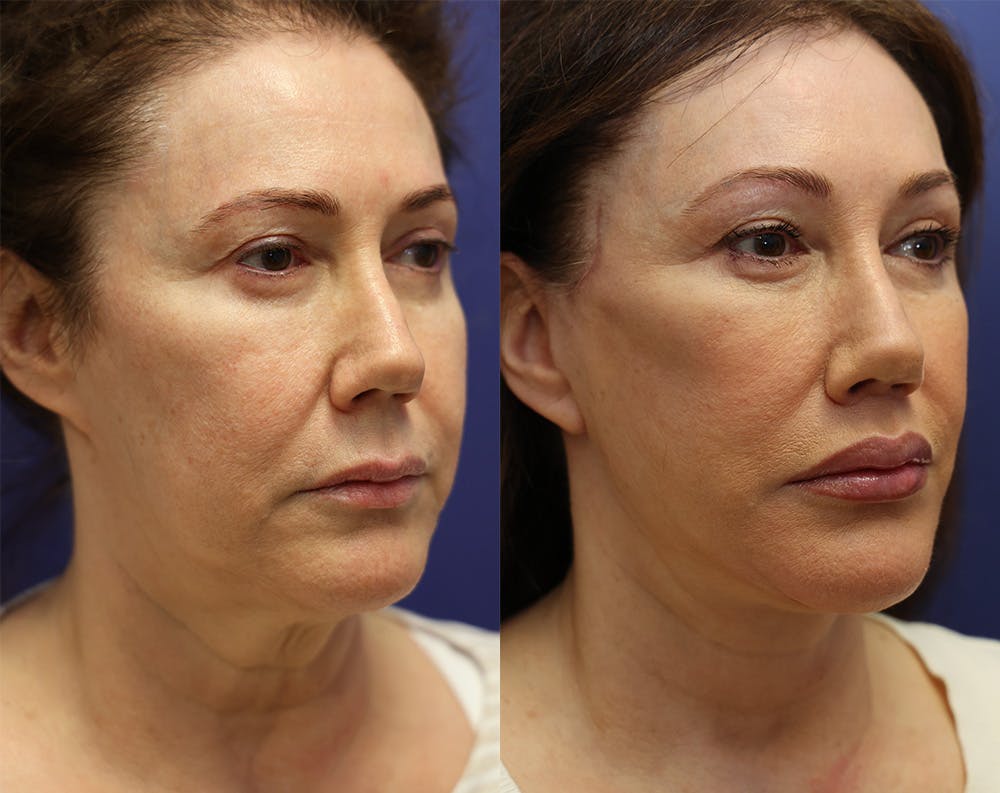 Deep Plane Neck Lift Before & After Gallery - Patient 147104382 - Image 3