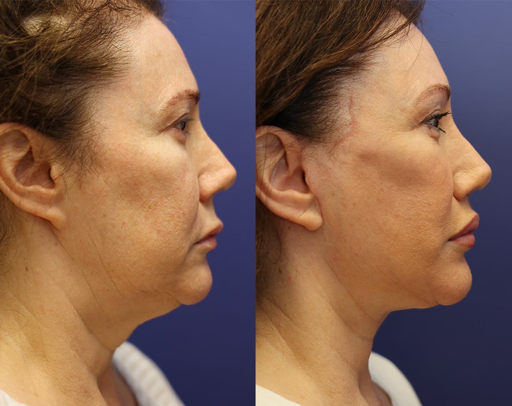 Lip Lift Before & After Gallery - Patient 147104395 - Image 3