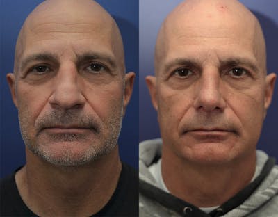 Rhinoplasty (Nose Reshaping) Before & After Gallery - Patient 147104425 - Image 1