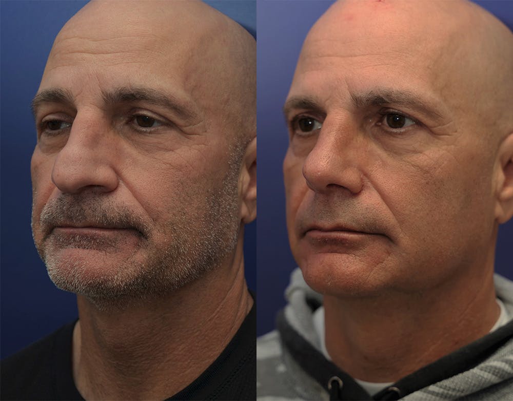 Rhinoplasty (Nose Reshaping) Before & After Gallery - Patient 147104425 - Image 2