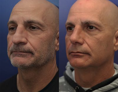 Rhinoplasty (Nose Reshaping) Before & After Gallery - Patient 147104425 - Image 2