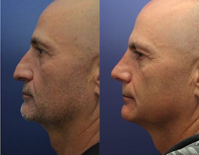 Rhinoplasty (Nose Reshaping) Before & After Gallery - Patient 147104425 - Image 1