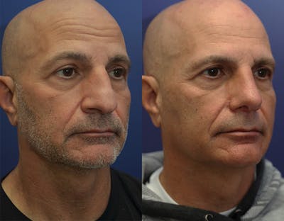 Rhinoplasty (Nose Reshaping) Before & After Gallery - Patient 147104425 - Image 4