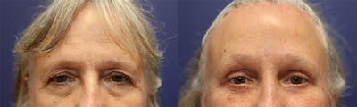 Eyelid Surgery Before & After Gallery - Patient 147104443 - Image 1
