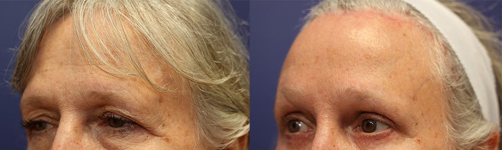 Brow Lift (Forehead Lift) Before & After Gallery - Patient 147104441 - Image 2