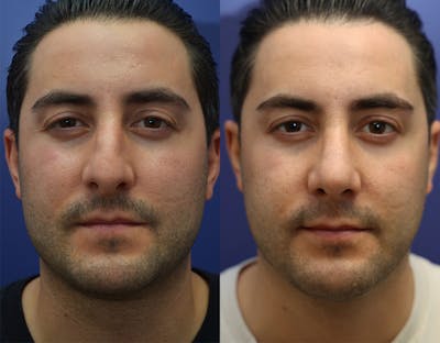 Rhinoplasty (Nose Reshaping) Before & After Gallery - Patient 147104478 - Image 1
