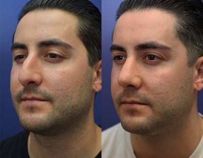 Rhinoplasty (Nose Reshaping) Before & After Gallery - Patient 147104478 - Image 4