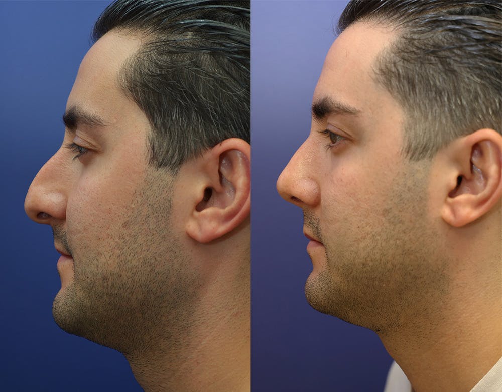 Rhinoplasty (Nose Reshaping) Before & After Gallery - Patient 147104478 - Image 5