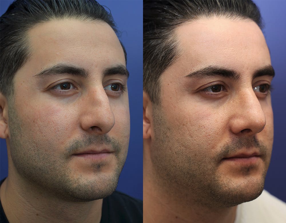 Rhinoplasty (Nose Reshaping) Before & After Gallery - Patient 147104478 - Image 2