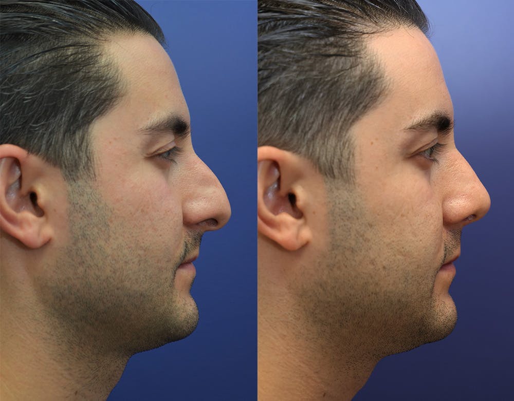 Rhinoplasty (Nose Reshaping) Before & After Gallery - Patient 147104478 - Image 3