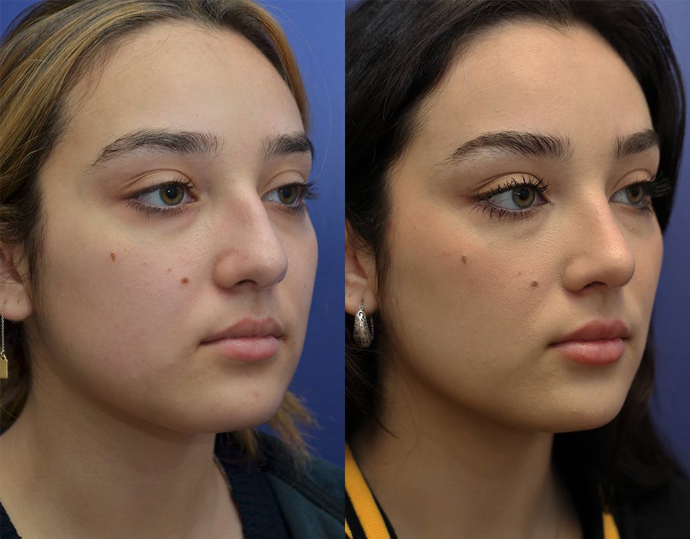 Rhinoplasty (Nose Reshaping) Before & After Gallery - Patient 147739680 - Image 2