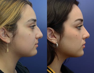 Rhinoplasty (Nose Reshaping) Before & After Gallery - Patient 147739680 - Image 4