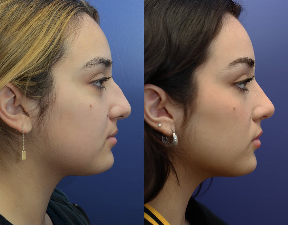 Rhinoplasty (Nose Reshaping) Before & After Gallery - Patient 147739680 - Image 4