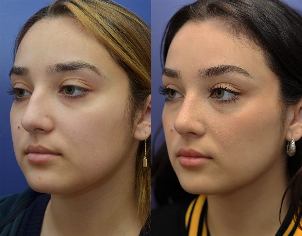 Rhinoplasty (Nose Reshaping) Before & After Gallery - Patient 147739680 - Image 1