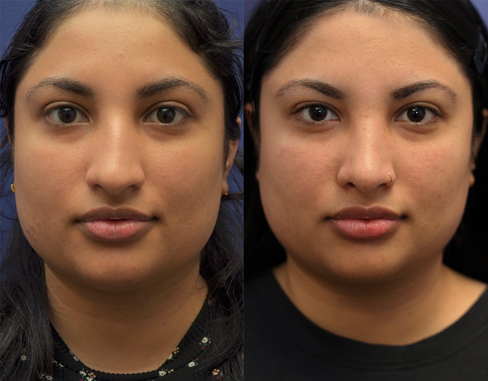 Rhinoplasty (Nose Reshaping) Before & After Gallery - Patient 141526208 - Image 3