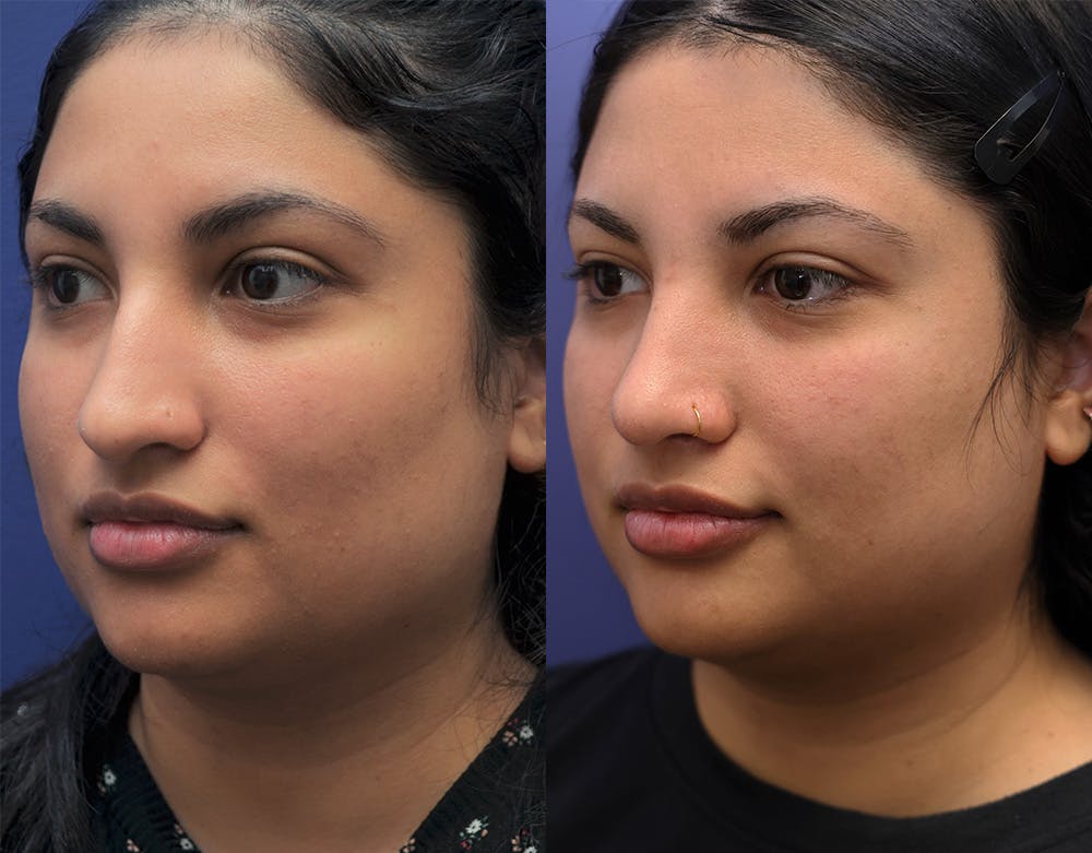 Rhinoplasty (Nose Reshaping) Before & After Gallery - Patient 141526208 - Image 5
