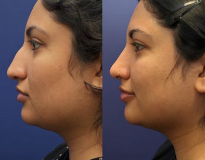 Rhinoplasty (Nose Reshaping) Before & After Gallery - Patient 141526208 - Image 4
