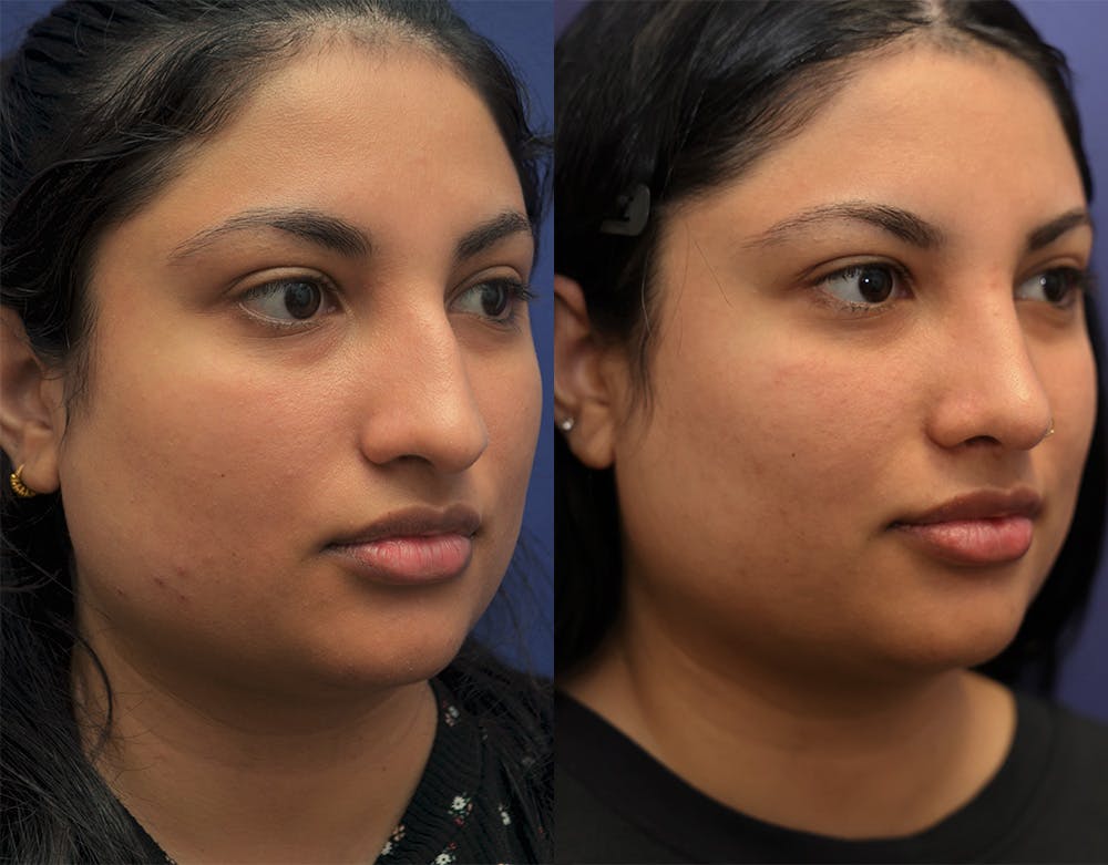 Rhinoplasty (Nose Reshaping) Before & After Gallery - Patient 141526208 - Image 1