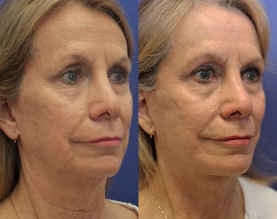 Deep Plane Facelift Before & After Gallery - Patient 140400354 - Image 4