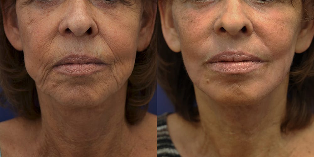 CO2 Laser Resurfacing Before & After Gallery - Patient 160185145 - Image 1