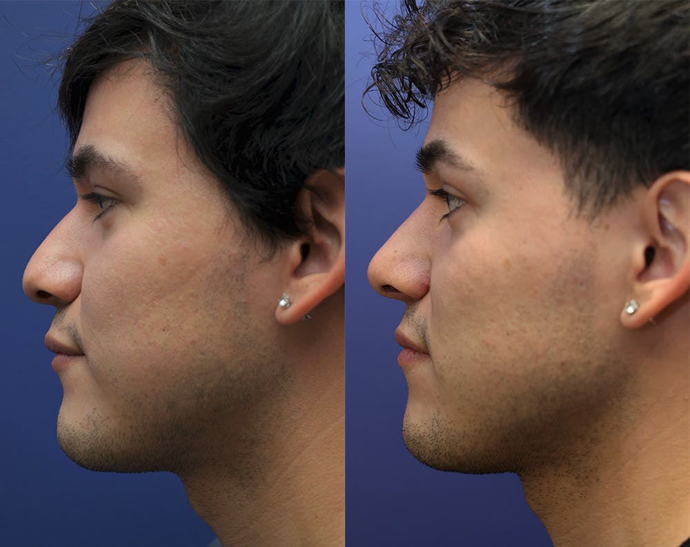 Rhinoplasty (Nose Reshaping) Before & After Gallery - Patient 148163913 - Image 2