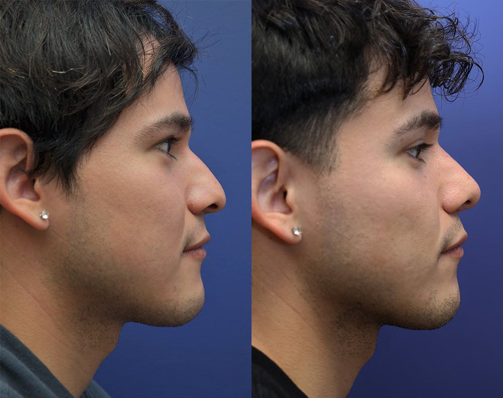 Rhinoplasty (Nose Reshaping) Before & After Gallery - Patient 148163913 - Image 1
