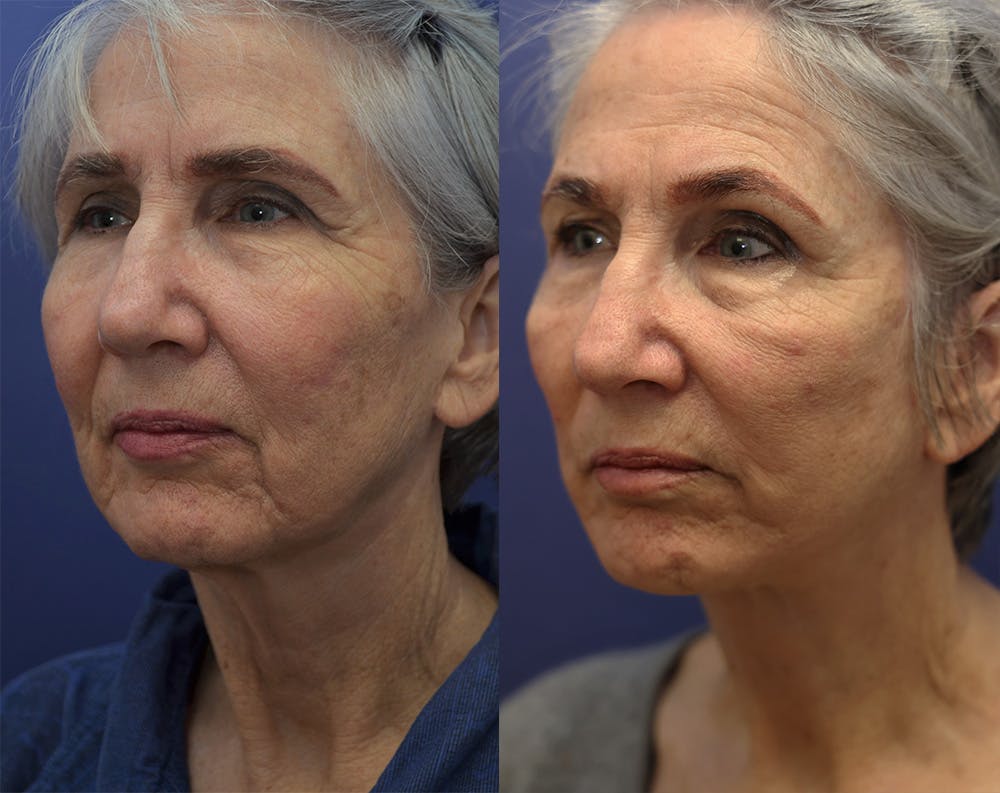 Deep Plane Facelift Before & After Gallery - Patient 144657198 - Image 1