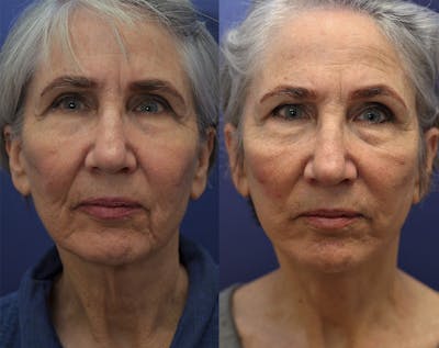 Deep Plane Facelift Before & After Gallery - Patient 144657198 - Image 2