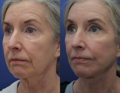 Facelift Before & After Gallery - Patient 122581145 - Image 1
