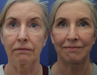 CO2 Laser Resurfacing Before & After Gallery - Patient 160185148 - Image 2