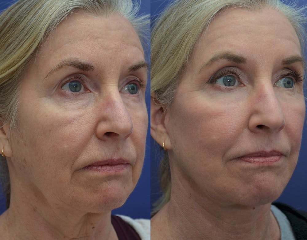 CO2 Laser Resurfacing Before & After Gallery - Patient 160185148 - Image 4