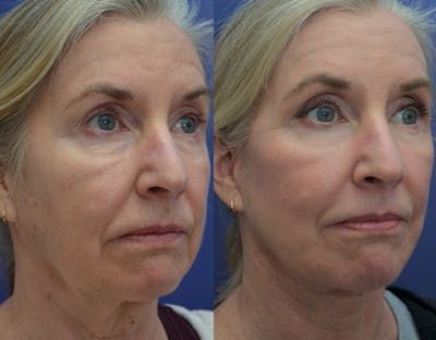 Deep Plane Facelift Before & After Gallery - Patient 122581145 - Image 4