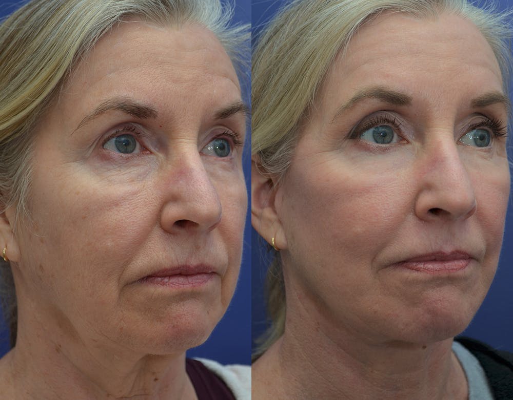 Deep Plane Facelift Before & After Gallery - Patient 122581145 - Image 4
