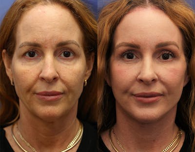 Eyelid Surgery Before & After Gallery - Patient 223627 - Image 1