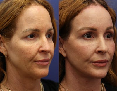 Eyelid Surgery Before & After Gallery - Patient 223627 - Image 2