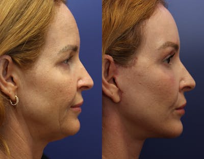 Deep Plane Facelift Before & After Gallery - Patient 149295891 - Image 4